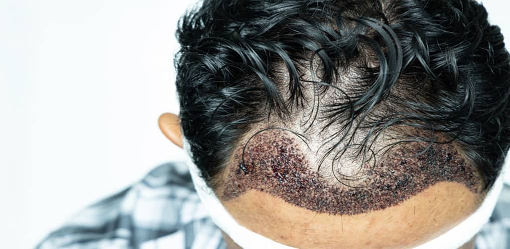 FUE Hair Transplant in Turkey