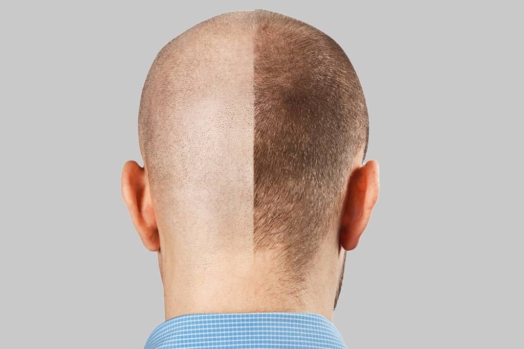 Body Hair Transplant in Turkey