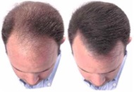NeoGraft for Hair Transplant in Turkey