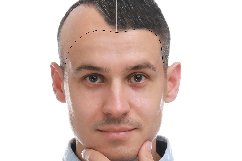 Results after a Hair Transplant in Turkey