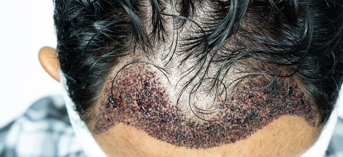 Sapphire Hair Transplant in Turkey